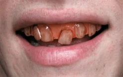 Rotten Goblin SFX Veneer Zähne